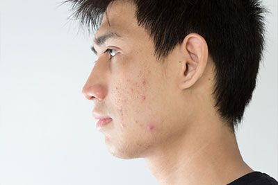 what causes acne on cheeks
